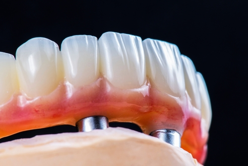 Dental photography of full arch zircon bridge on implants