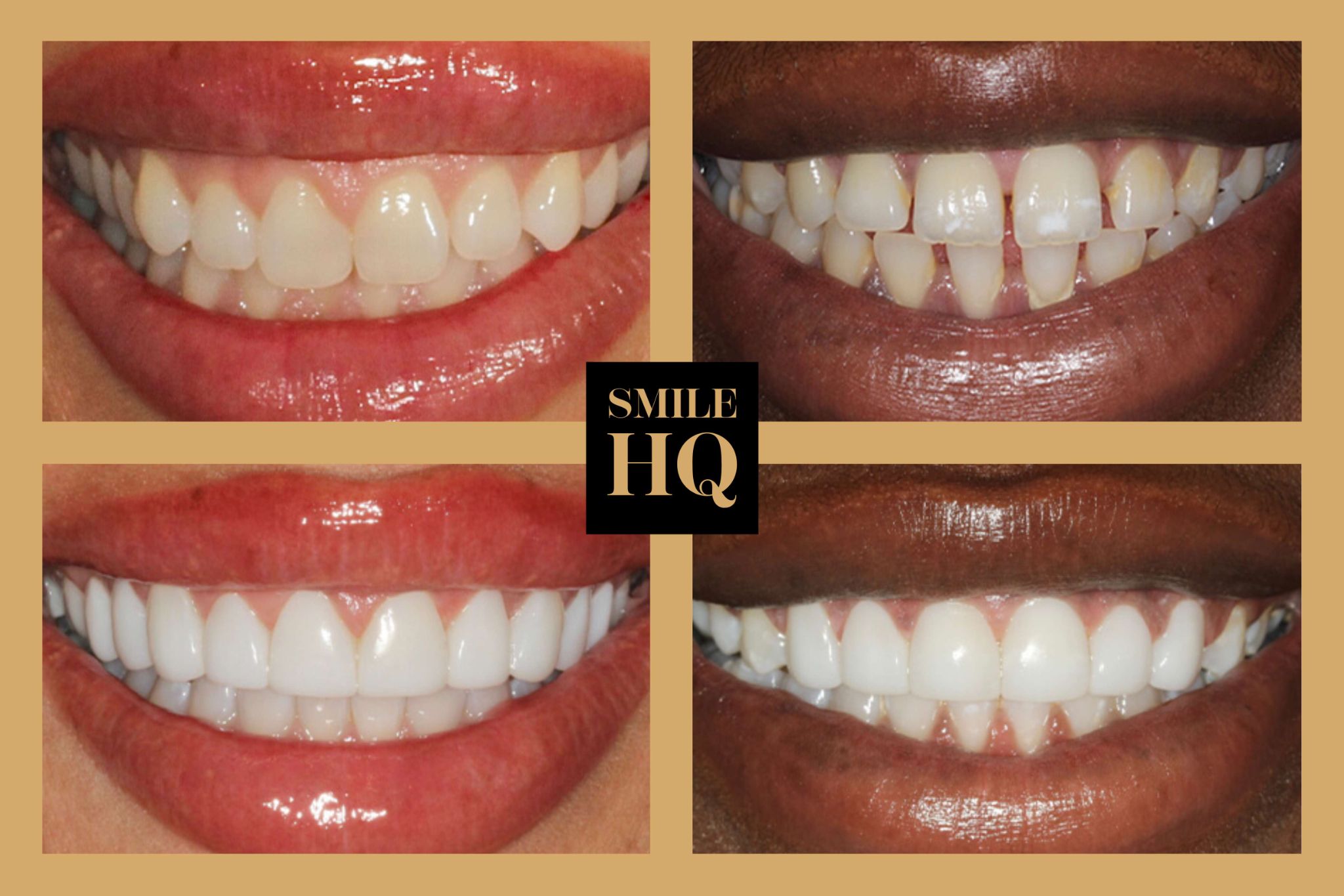 Before and after professional teeth whitening results achieved at SmileHQ in Essex, showing improved tooth colour and brightness