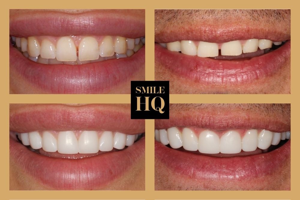 Composite bonding before and after smile transformation at SmileHQ Essex