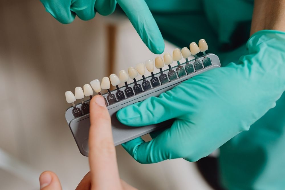 Selecting a tooth shade for composite bonding treatment in Essex