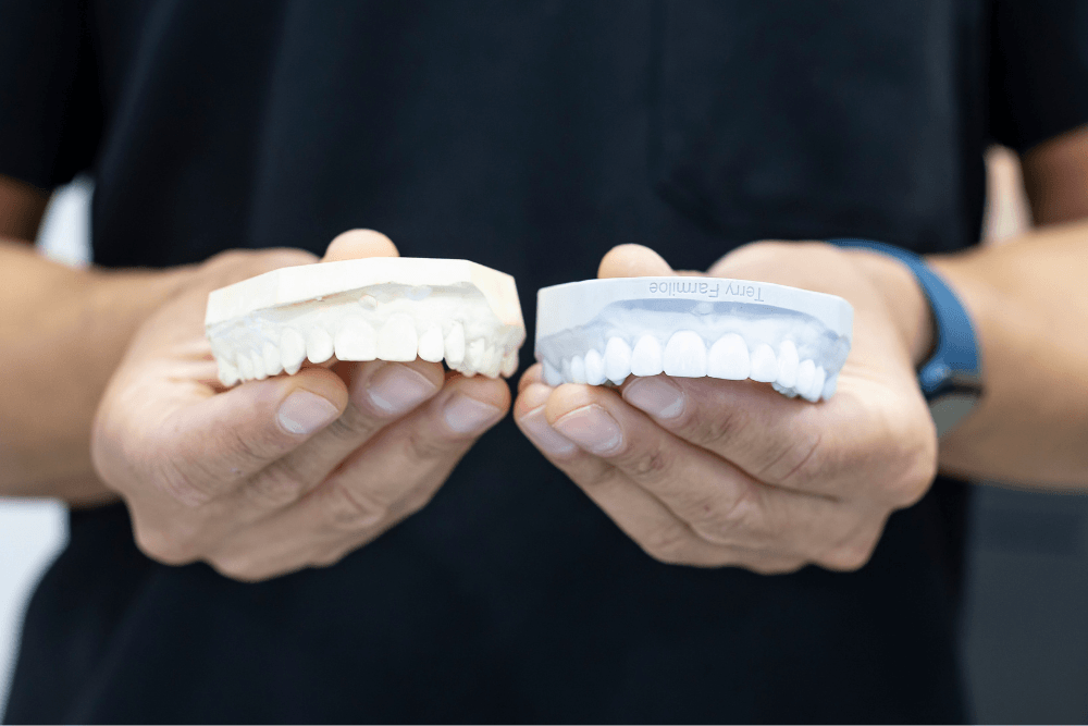 Dental models showing different tooth shapes and smile designs