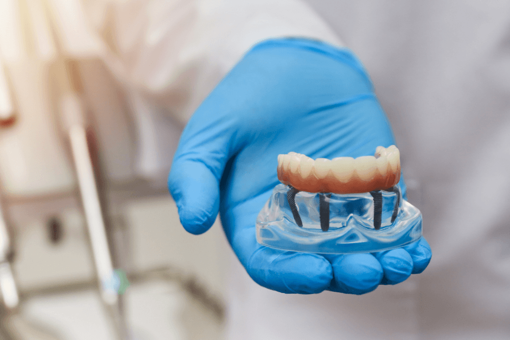 All-on-4 dental implant bridge supported by four implants