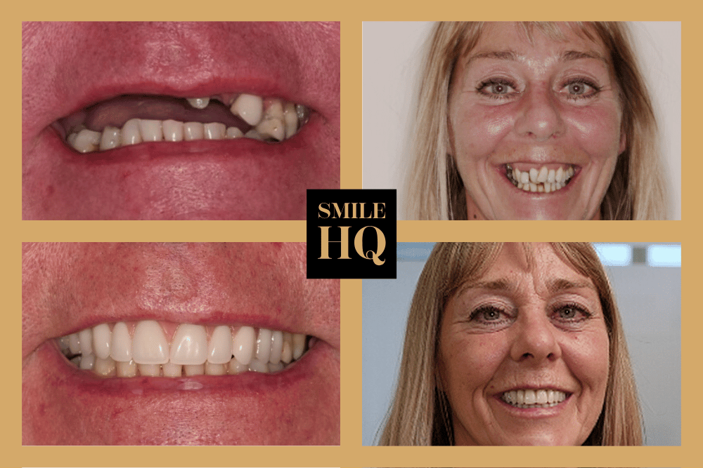 Before and after dental implant treatment completed by Implant Surgeon Dr Vishal Patel at SmileHQ Essex